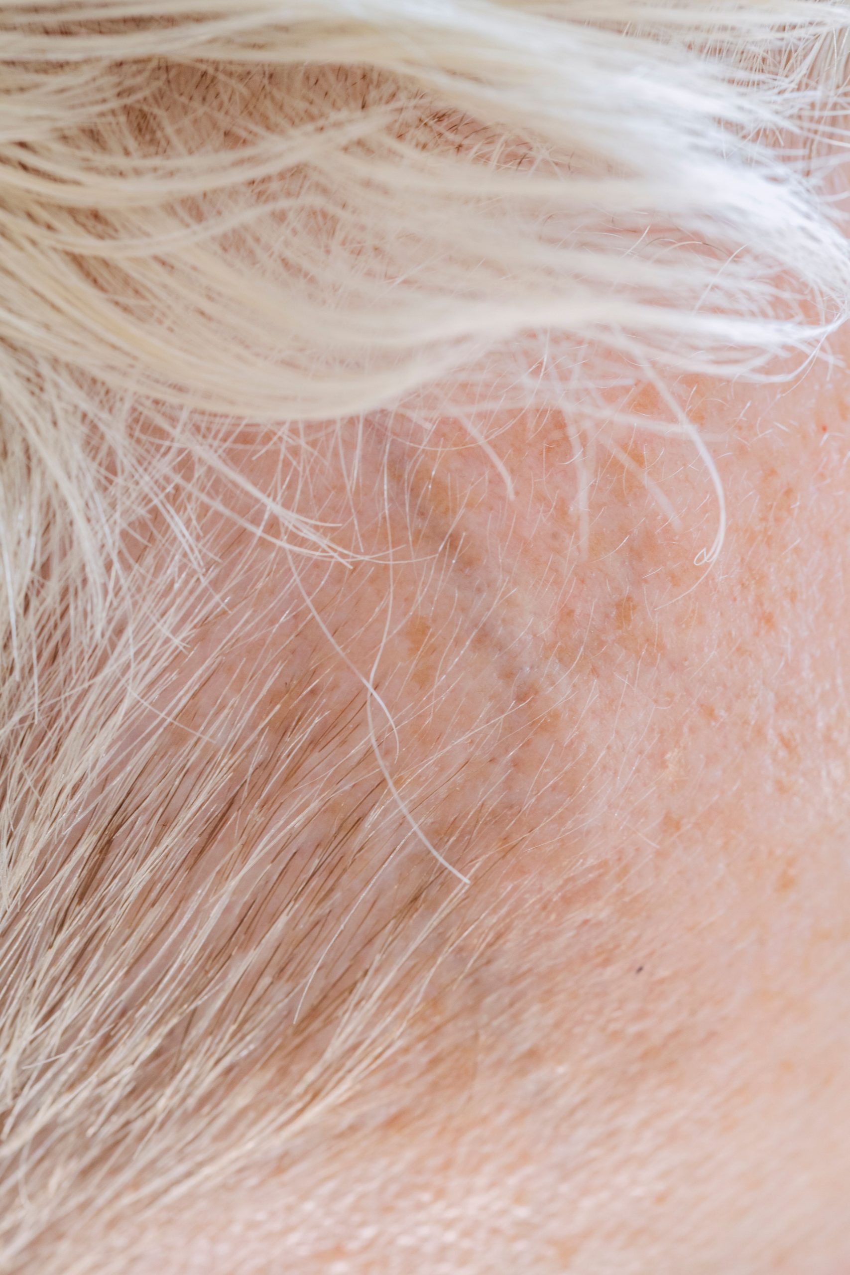 Pourquoi apparaissent les boutons sur le cuir chevelu