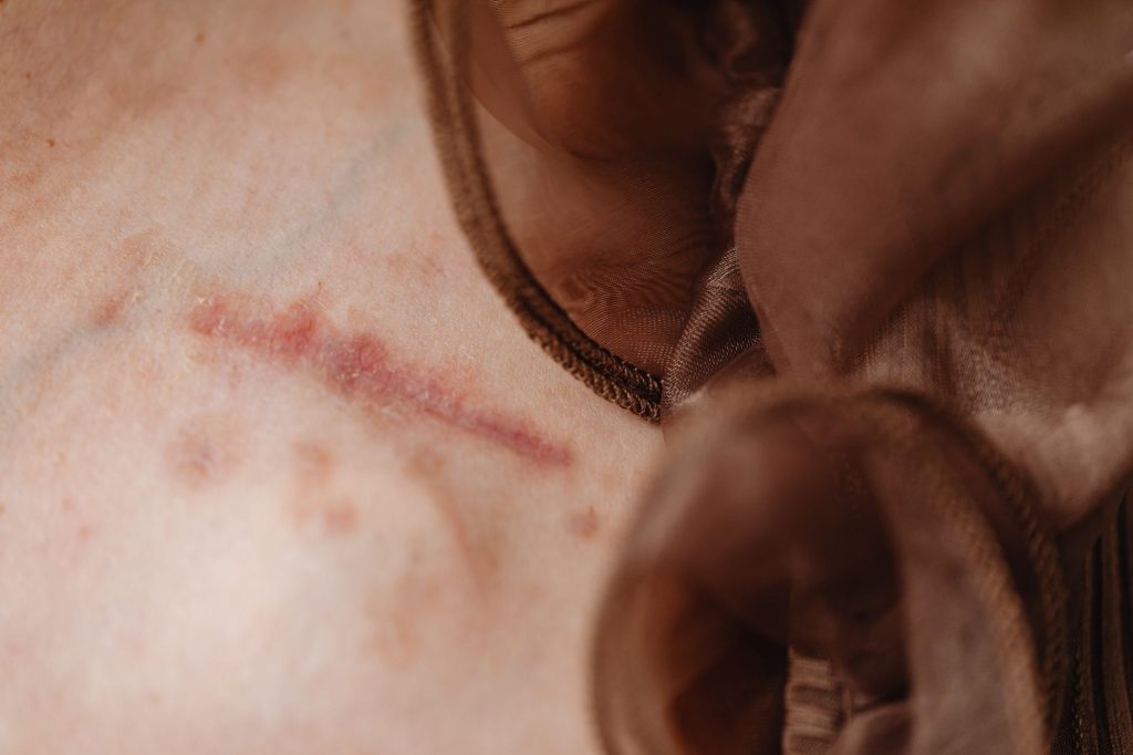 Cicatrice après une suture sur la peau