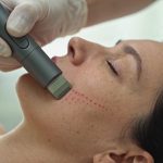 microneedling en 2026