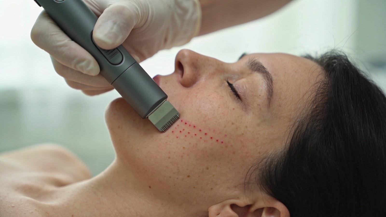 microneedling en 2026